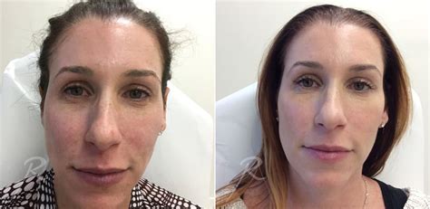 Toradh íomhá ar Before and After Needling Procedures