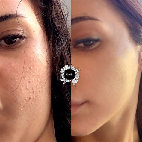 Image result for Back and Chest Pimple Popping