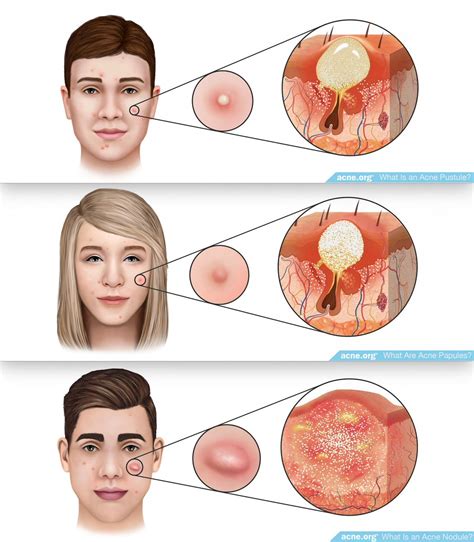Inside Nodule Acne に対する画像結果