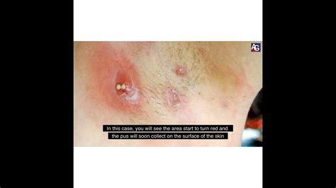 Carbuncle Symptoms に対する画像結果