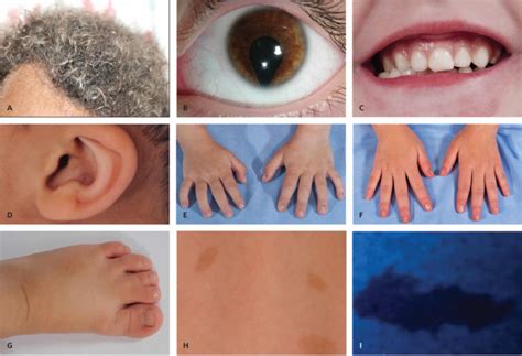 Image result for Dysmorphologies