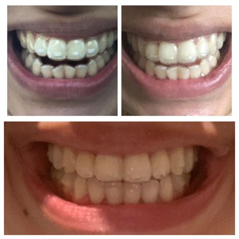 Toradh íomhá ar Invisalign Light