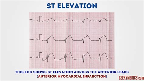 How to Read EKG Monitor కోసం చిత్ర ఫలితం