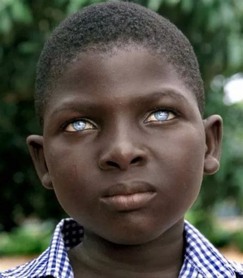 Light Blue Eyes Albinism に対する画像結果