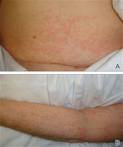 Image result for Delayed Allergic Reaction