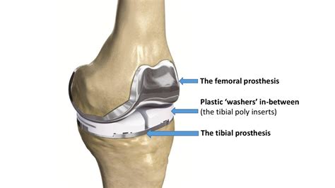 Image result for PF Joint-Replacement