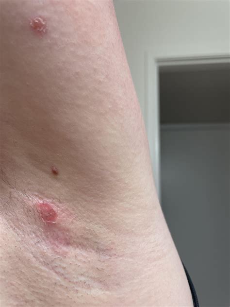 Image result for Painful Pimple Under Armpit