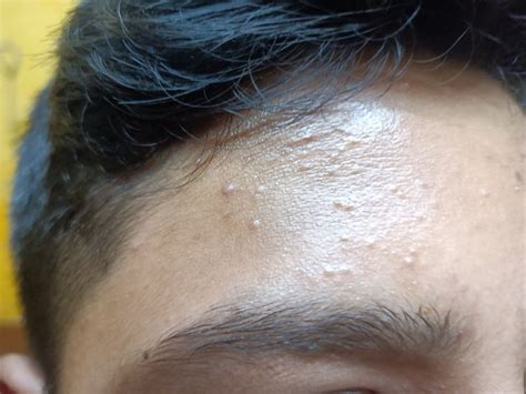 Image result for Closed Comedones Nose Nose