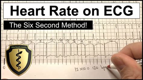 Toradh íomhá ar 6 Step Method ECG