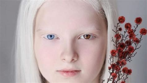 Light Blue Eyes Albinism に対する画像結果