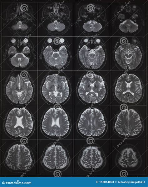 Image result for Normal Brain MRI
