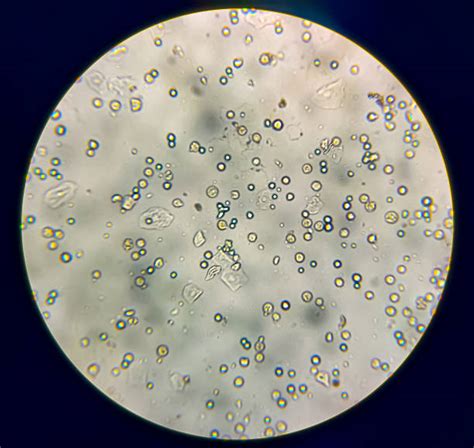 Image result for Round Clear in Microscopic Urine
