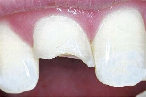 Image result for Broken Tooth Bleeding