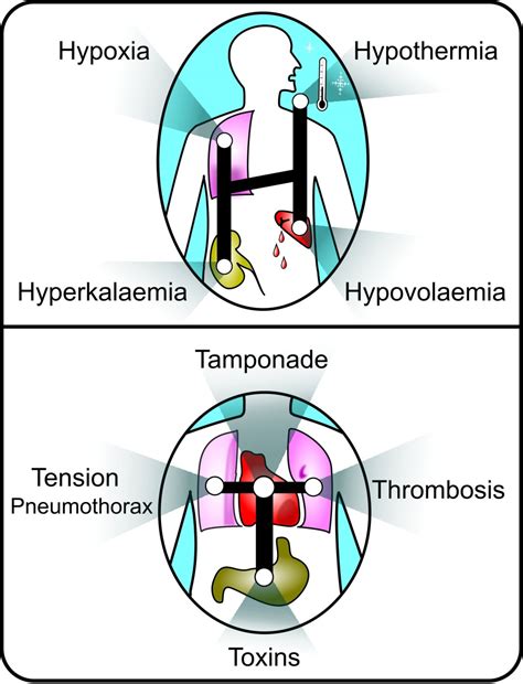 Toradh íomhá ar Als Cardiac Arrest Algorithm