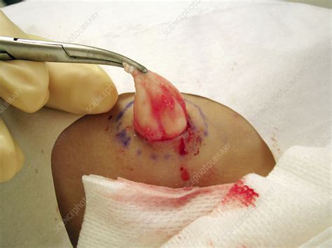 Exploding Cyst Sac に対する画像結果