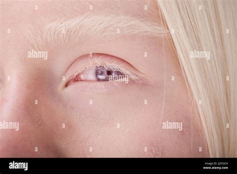 Light Blue Eyes Albinism に対する画像結果