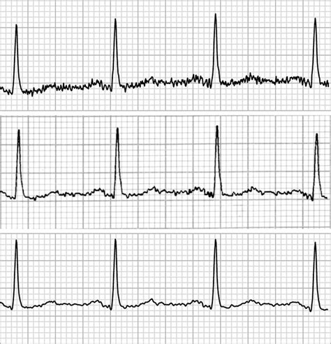 Hand Based ECG Signal に対する画像結果