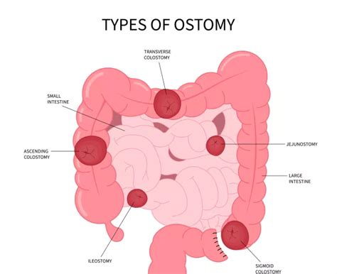Image result for Types of Colostomy