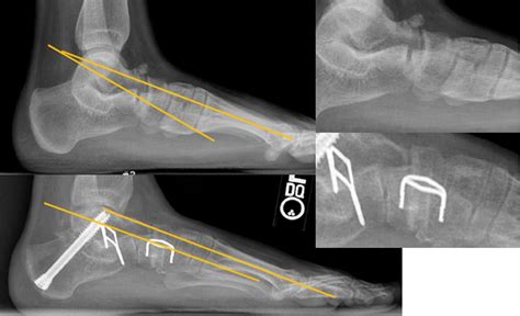 Image result for Pes Planovalgus