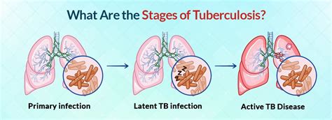 Image result for Tuberculosis Latent Stage