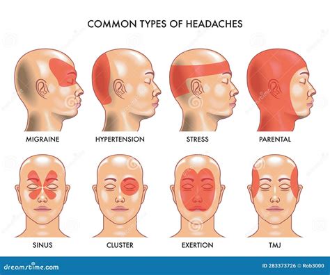Different Types of Migraines Chart-साठीचा प्रतिमा निकाल