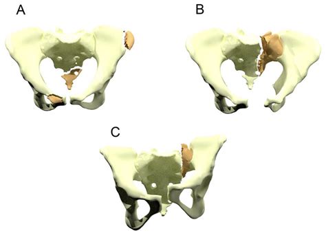 Toradh íomhá ar Tile Pelvis Fracture