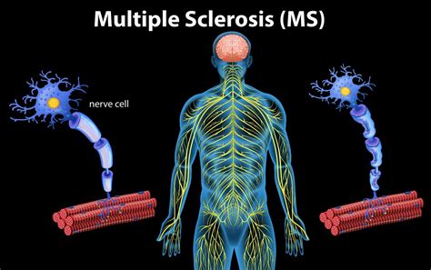 Image result for Multiple Sclerose MS