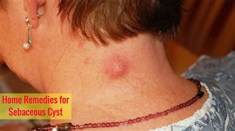 DIY Remove Sebaceous Cyst に対する画像結果