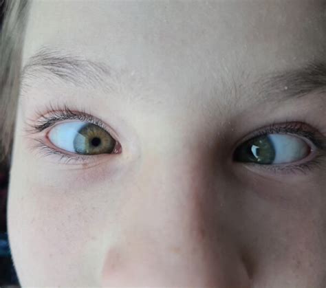 Toradh íomhá ar Visual Processing Deficits