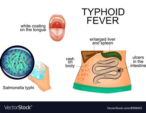 Image result for Typhoid Fever Disease