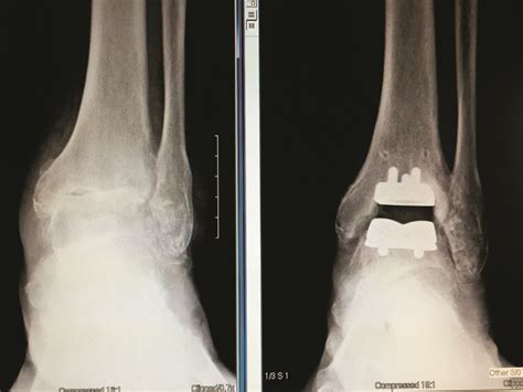 What Is an Ankle Replacement に対する画像結果