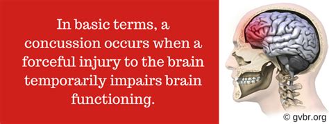 Toradh íomhá ar Concussion Definition