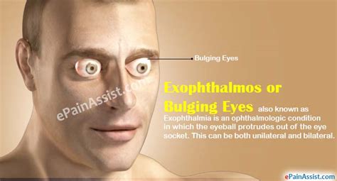 Image result for Exopthalmia