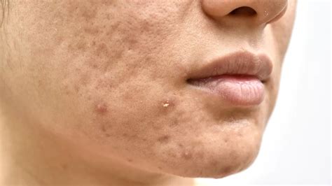 Toradh íomhá ar Jenis Jenis Acne