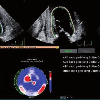 Toradh íomhá ar Speckle Tracking Algorithm