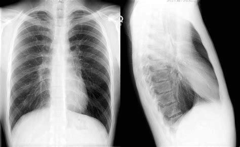Flat Diaphragm CXR に対する画像結果