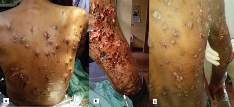 Image result for Mango Worms in Humans