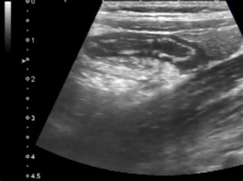 Image result for Abdominal Compression