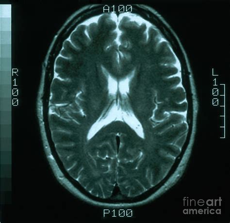 Image result for Normal Brain MRI