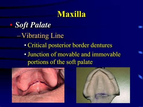 Image result for Soft Palate Dentures