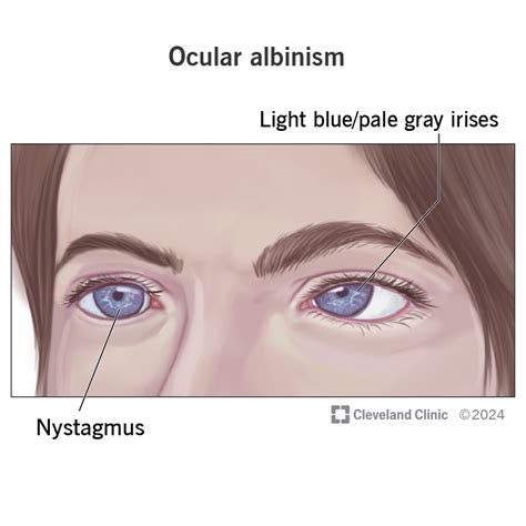 Light Blue Eyes Albinism に対する画像結果