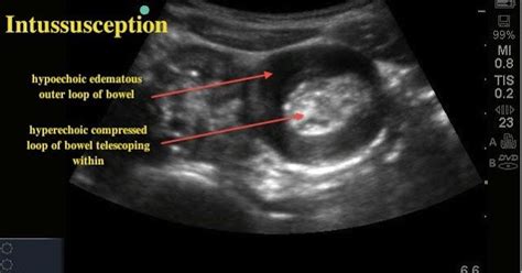 Image result for What Is Being Image When Looking for Intussusception in a Baby On Ultrasound
