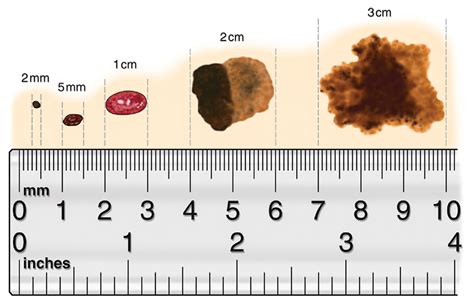Toradh íomhá ar Sizes of Cutaneous Defect