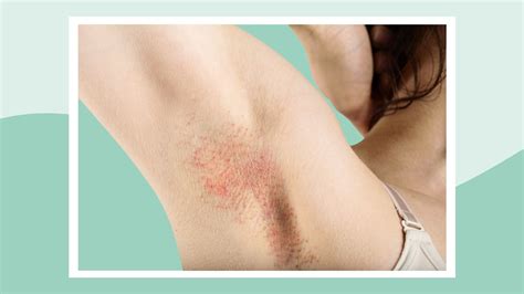 Image result for Painful Pimple Under Armpit