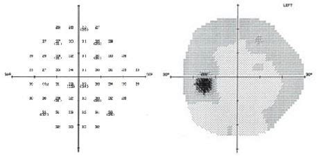 How Visual Field Testing Is Done కోసం చిత్ర ఫలితం