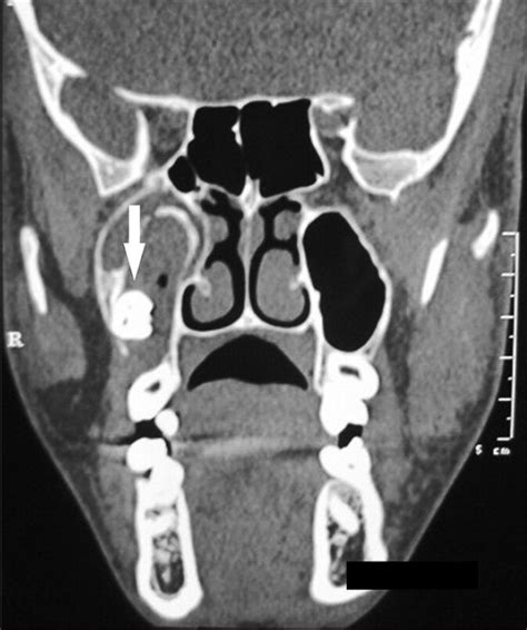 Image result for Maxillary Cyst