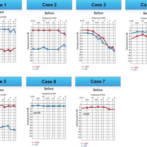 Afbeeldingsresultaten voor Ossicular Disarticulation Tympanogram