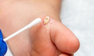 Best Way to Remove Calluses に対する画像結果