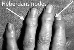 Image result for How to Get Rid of Hererdens Nodes