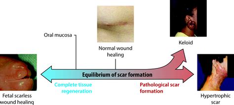 Image result for Scar Tissue Color Curve